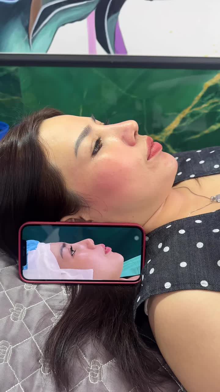 MŨI CẤU TRÚC SAU 1 THÁNG – DÁNG MŨI ĐẸP TỰ NHIÊN, GƯƠNG MẶT THĂNG HẠNG