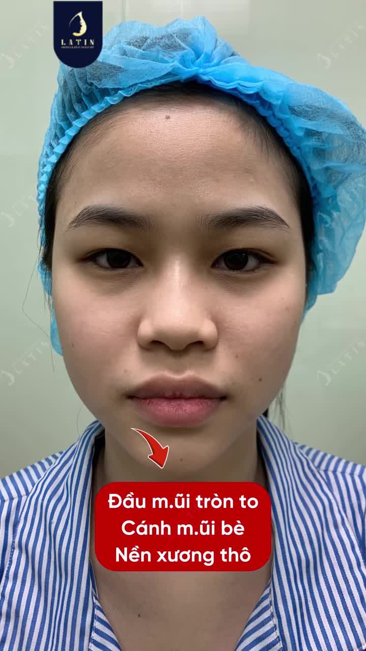 THÀNH CÔNG CỦA NGƯỜI ĐI NÂNG MŨI KHÔNG PHẢI LÀ CAO HƠN — MÀ LÀ...