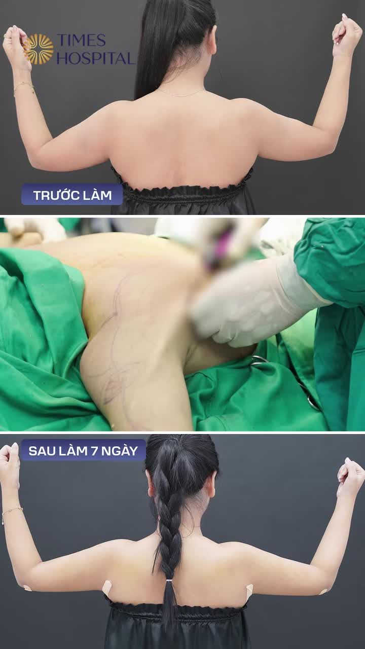 HÚT MỠ BẮP TAY – GỌN NGAY TỨC THÌ!