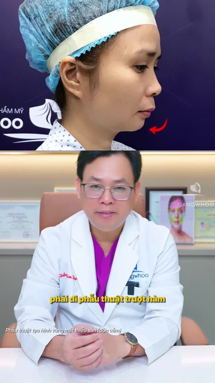 Độn cằm có giúp bớt hô không?