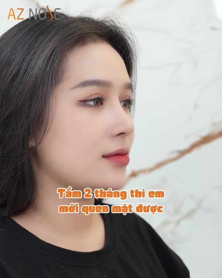 GenZ từng lựa chọn nâng mũi chỉ nhưng kết quả chưa đạt được như mong đợi.