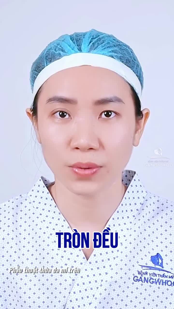 Mắt 1 mí, mí không đều nhau và kết quả xinh đẹp sau 1 tháng cắt mí tại Gangwhoo
