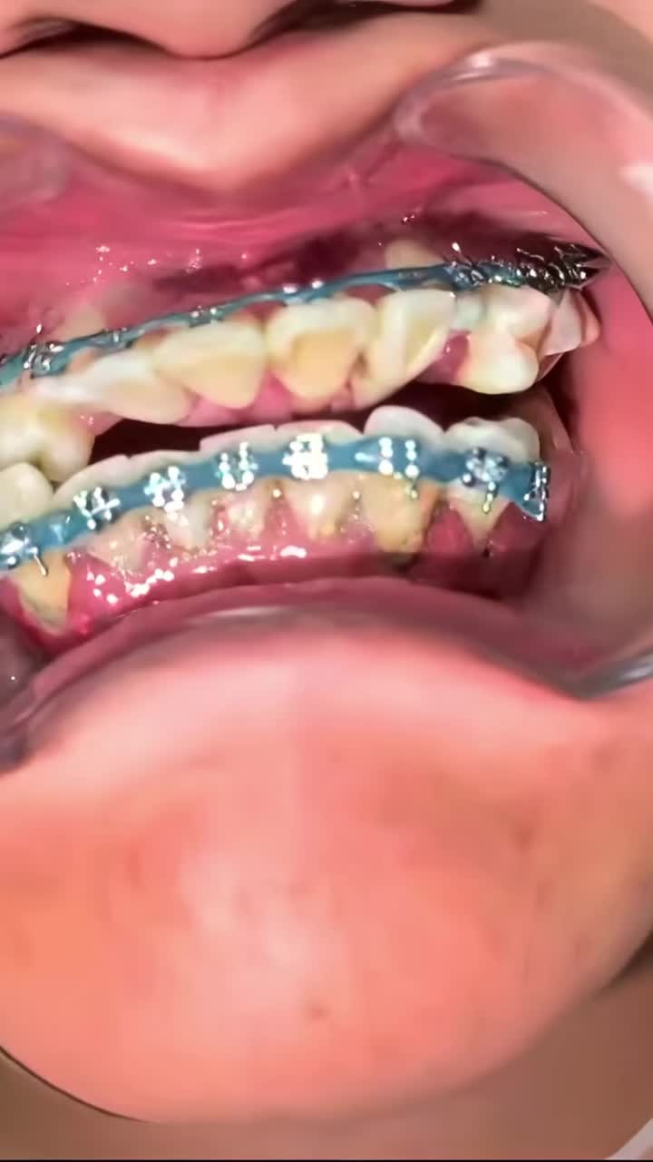 3 DẤU HIỆU NIỀNG RĂNG BỊ HỎNG
