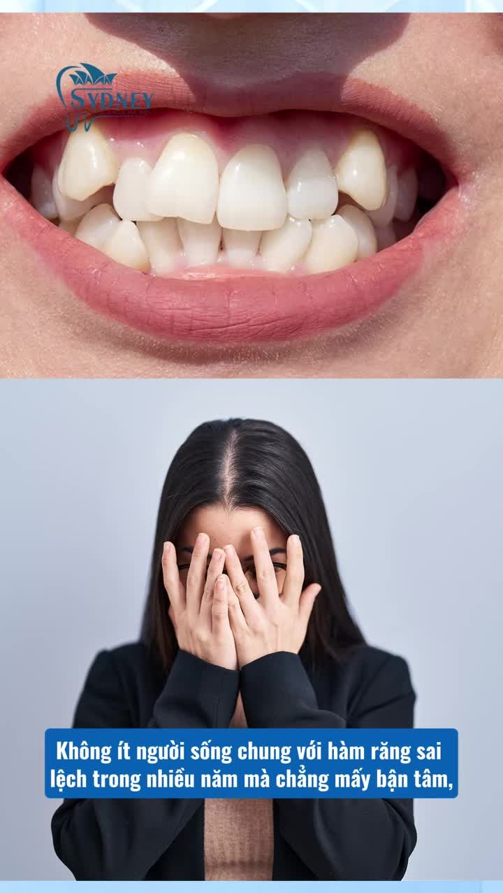 Răng sai lệch nhẹ có nên niềng không?