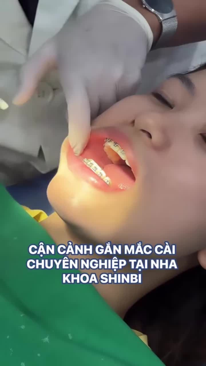 Cận cảnh gắn mắc cài chỉnh nha thẩm mỹ tại Nha khoa Shinbi