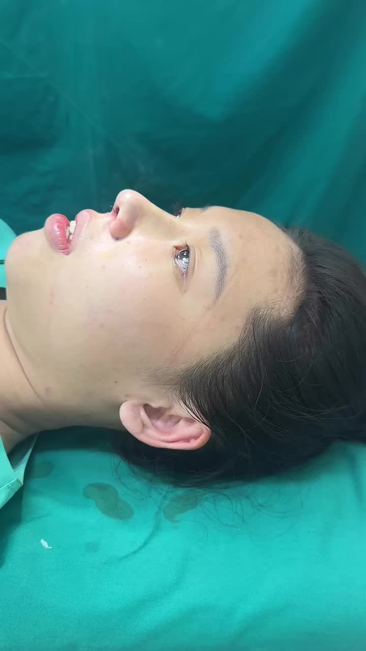 Mũi cấu trúc vừa hoàn thành