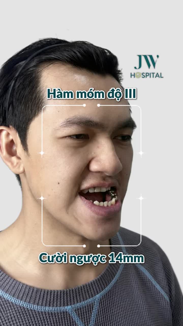 SODA CAMP LẶN LỘI TỪ CAMPUCHIA SANG VIỆT NAM PHẪU THUẬT HÀM, KẾT QUẢ LIỆU CÓ XỨNG ĐÁNG?