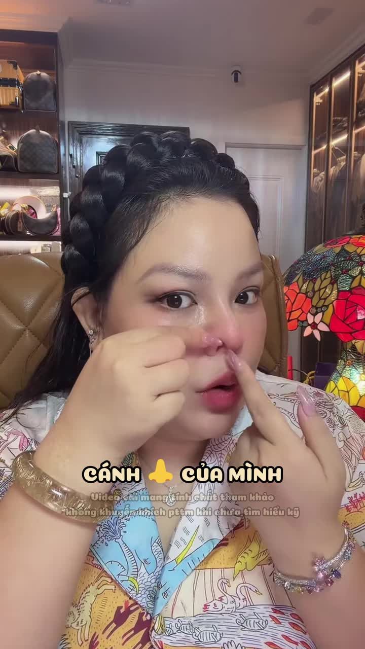 GHÉP CÁNH MŨI – HOÀN THIỆN DÁNG MŨI TỰ NHIÊN, HÀI HÒA