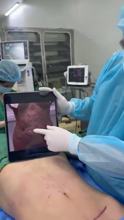 Sửa bụng lồi lõm sẹo xấu với Dr Vương
