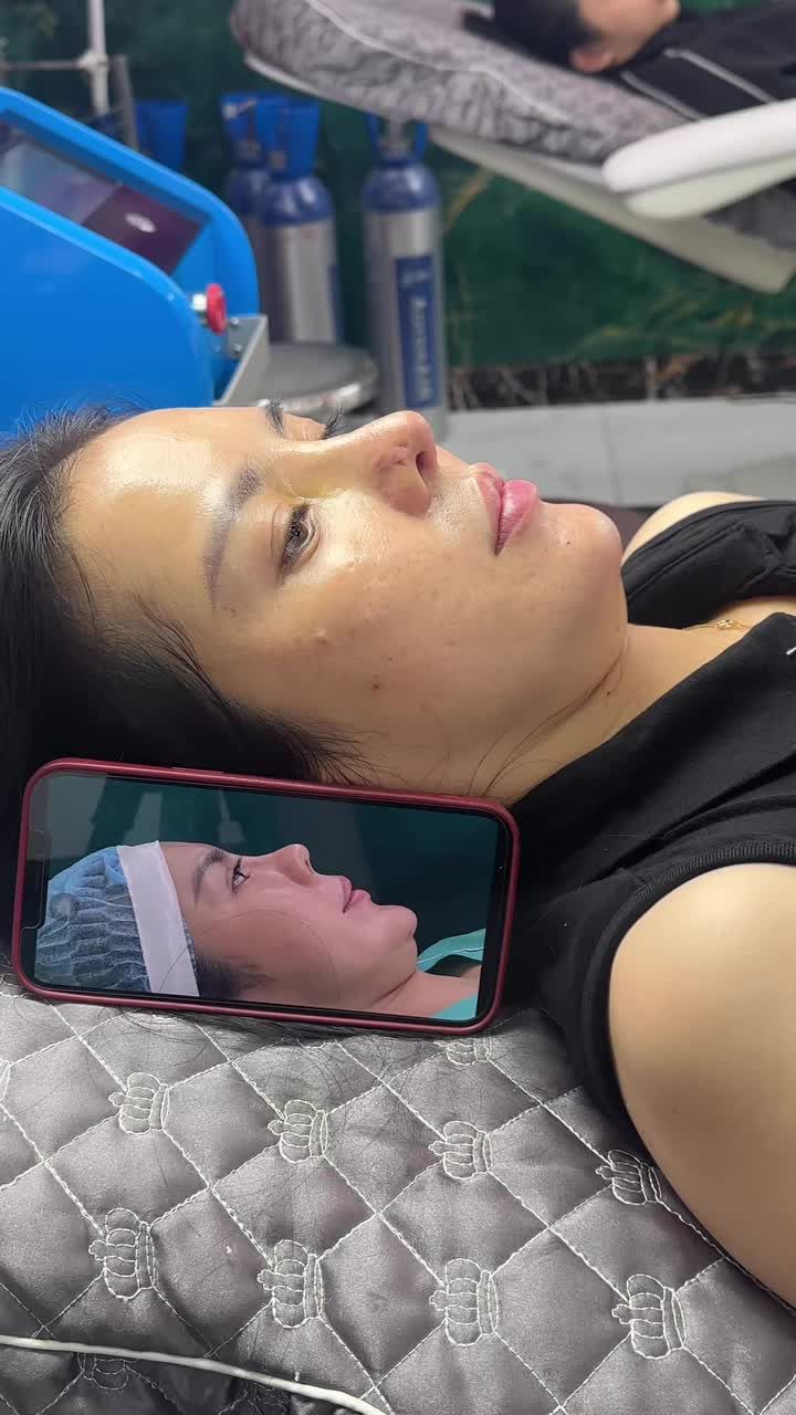 Mũi cấu trúc sửa lại ghép cánh sur