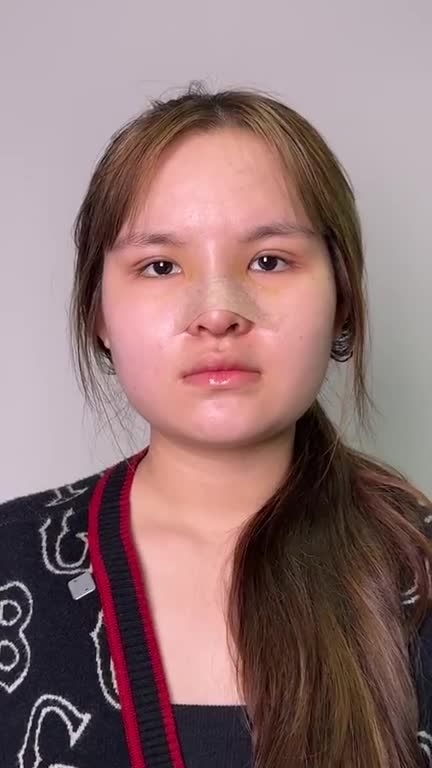 Em gái Gen Z đến JW NÂNG CẤP NHAN SẮC với NÂNG MŨI + CẮT MẮT
