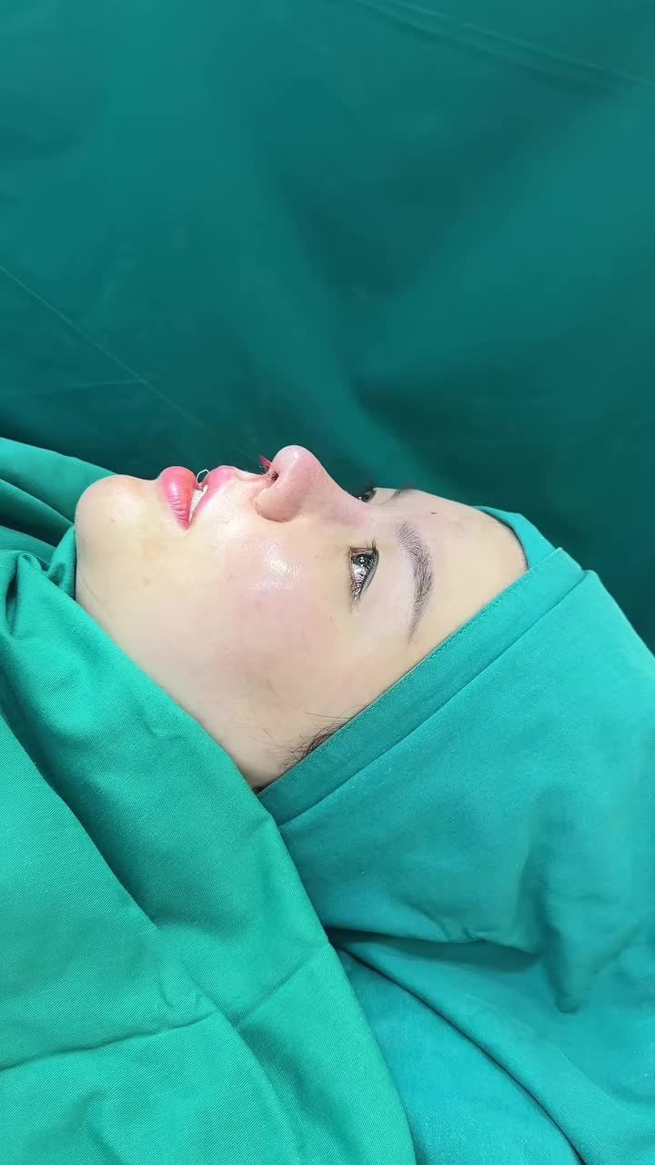 Mũi tái cấu trúc sur vừa hoàn thành