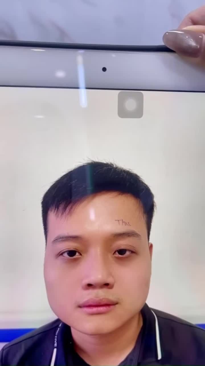Sau 6 tháng điều trị sụp mi bằng phương pháp thu cơ nâng mi, kết quả ngày càng hoàn thiện: