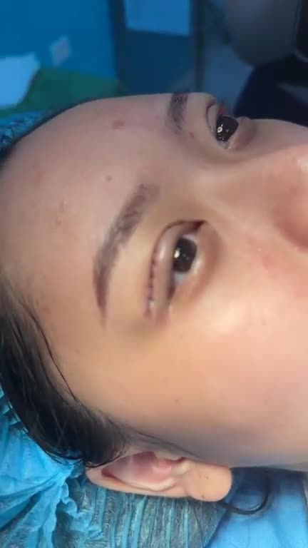 Cắt mí trên với Dr Vương