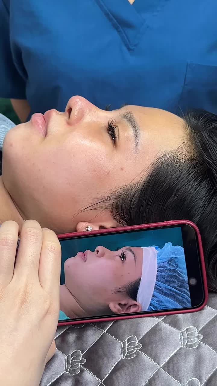 Mũi cấu trúc surgiform  sau 10 ngày