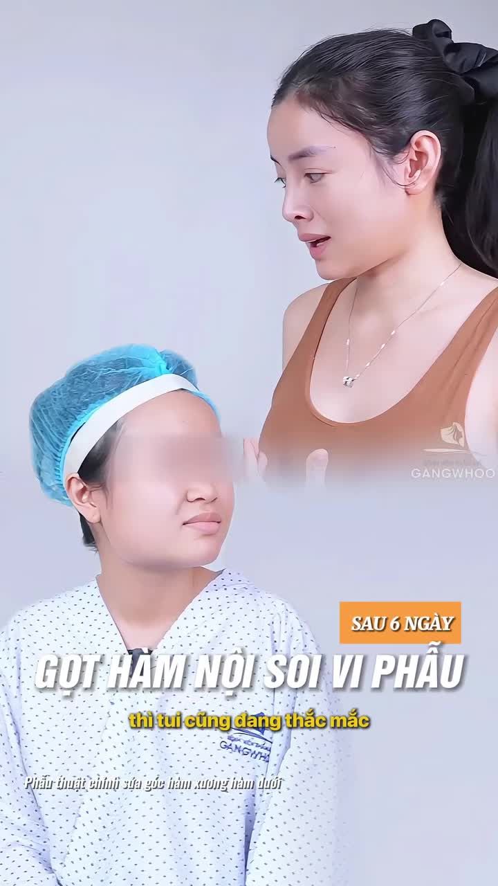 Người thật việc thật khách hàng sau 6 ngày thực hiện gọt hàm nội soi vi phẫu chia sẻ trải nghiệm cho bạn khách 2K8 an tâm chuẩn bị làm