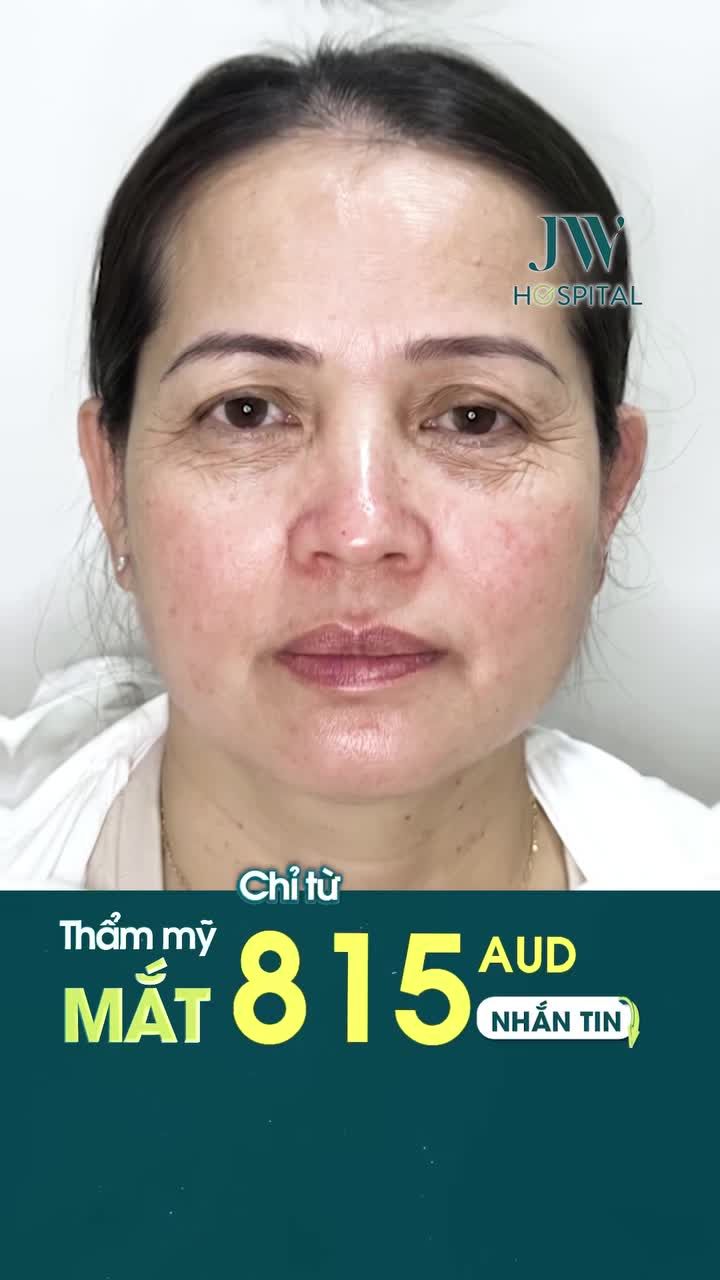 CHỈ 7 NGÀY VỀ VIỆT NAM VIỆT KIỀU ÚC ĐÃ TRẺ NGAY 10 TUỔI NHỜ TRẺ HOÁ MẮT TẠI JW