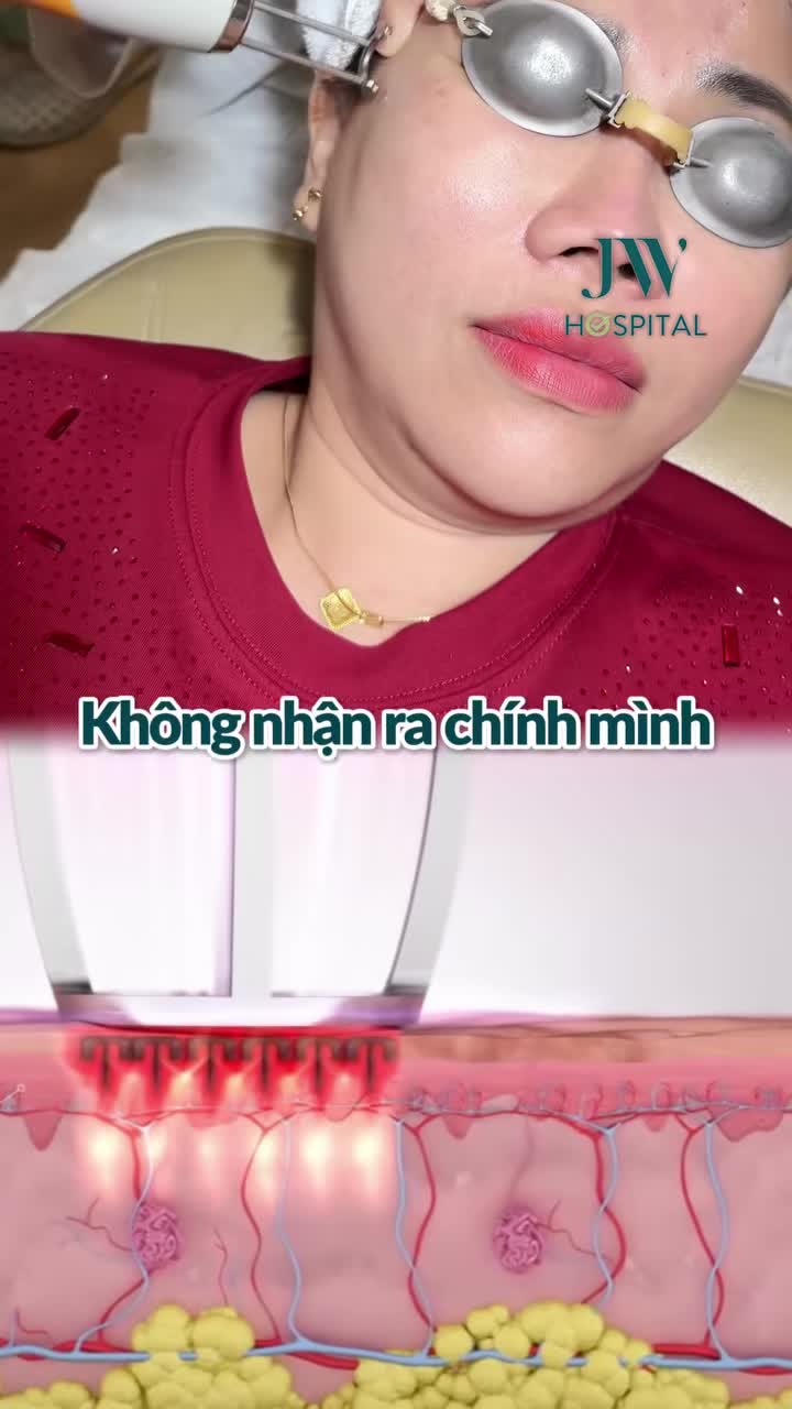 ĐÁNH BAY 90% NHĂN TRÁN, ĐUÔI MẮT CHO CHỊ GÁI 9X SAU 60 PHÚT TIÊM BOTOX + LASER TẠI JW