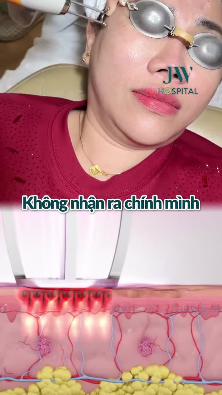 ĐÁNH BAY 90% NHĂN TRÁN, ĐUÔI MẮT CHO CHỊ GÁI 9X SAU 60 PHÚT TIÊM BOTOX + LASER TẠI JW