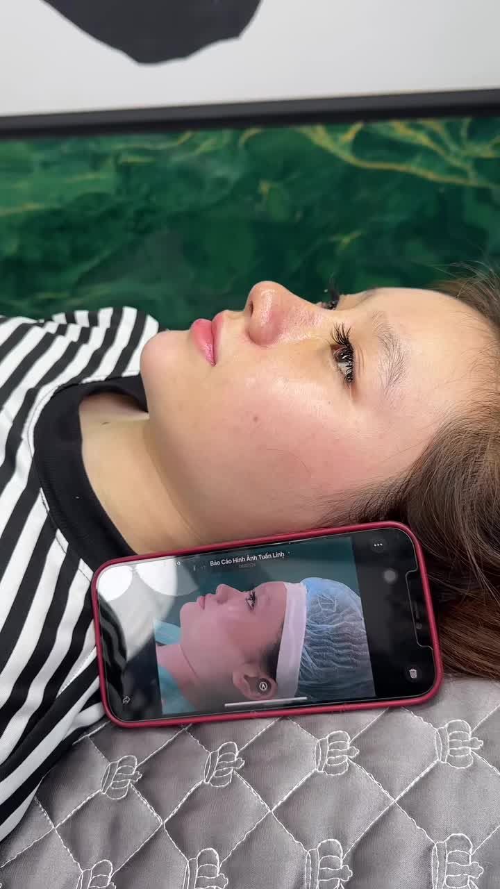 Mũi bọc sụn 5 ngày