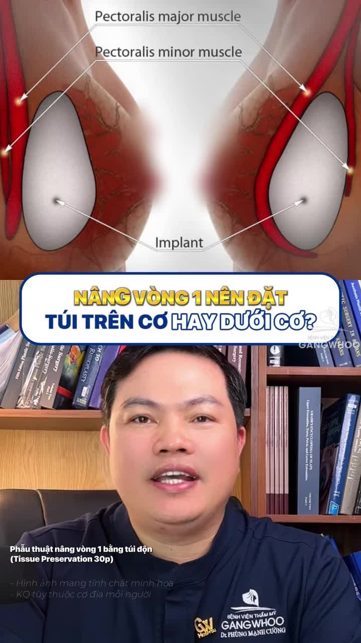 Nên nâng vòng 1 đặt túi trên cơ hay nâng vòng 1 đặt túi dưới cơ