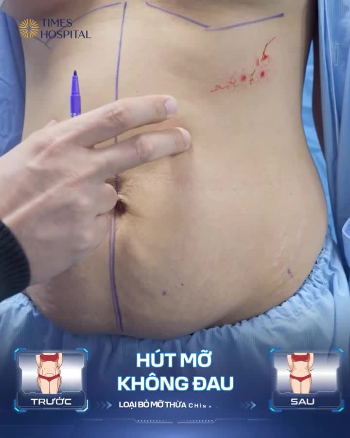 HÚT MỠ TẠO HÌNH ĐƯỜNG NÉT CAO – GIẢI PHÁP EO THON CHUẨN Y KHOA
