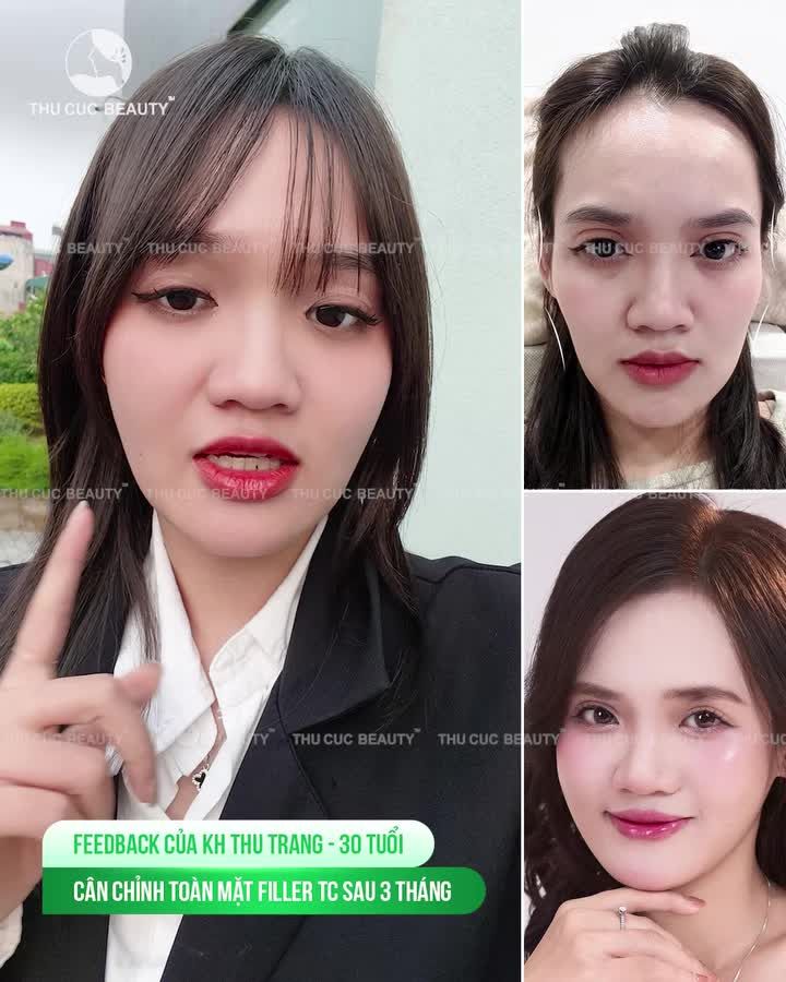 Feedback yêu thương của khách hàng: "3 tháng sau khi tiêm filler gương mặt hòa mô tự nhiên, mềm như thật!"