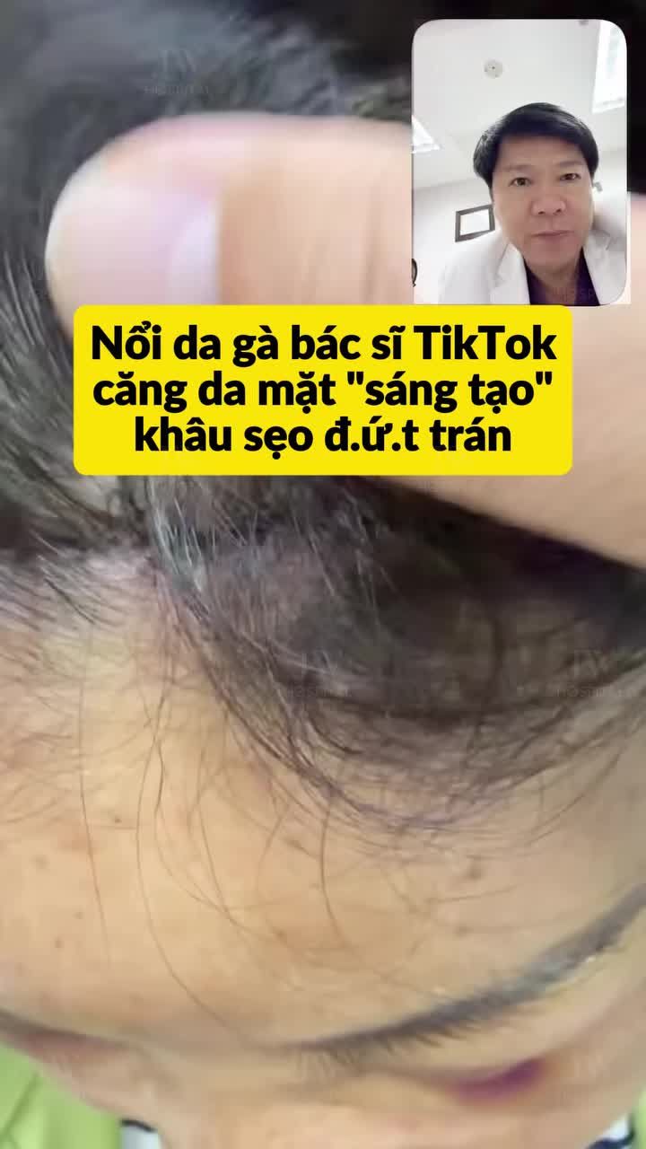 BÁC SĨ TÚ DUNG SỮNG SỜ TRƯỚC VẾT SẸO CẮT ĐỨT TRÁN SAU CĂNG DA MẶT TỪ “BÁC SĨ TIK TOK”