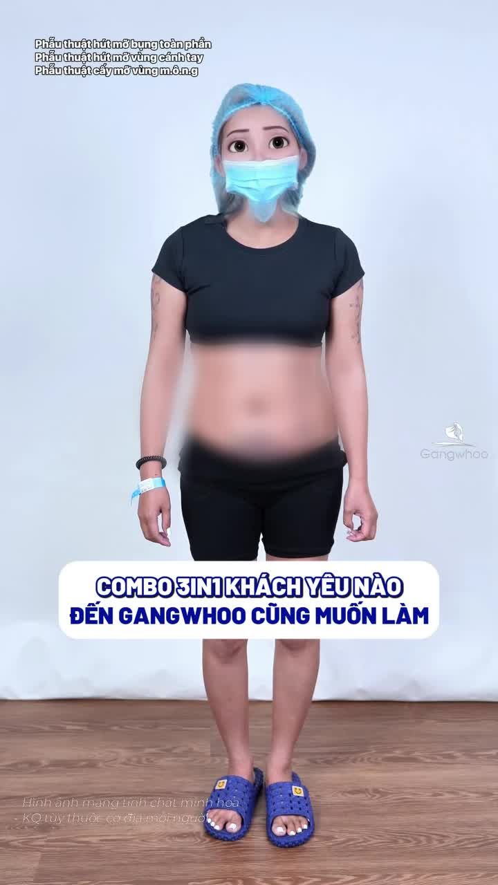 Giảm mỡ V2 - bắp tay - cấy mỡ V3 sau 1 ngày đi đứng, nhẹ nhàng không đau