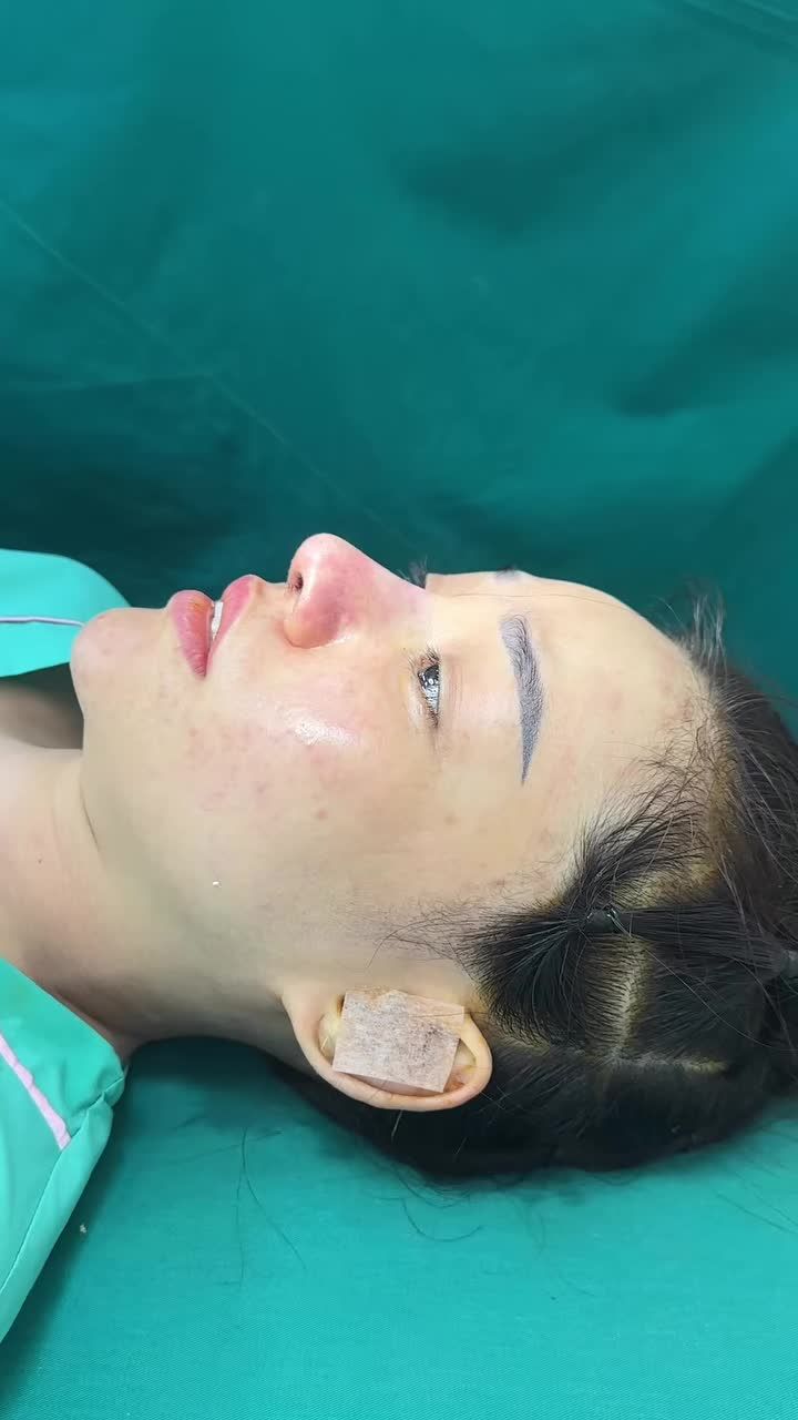 Mũi cấu trúc sửa lại surgiform đục xương