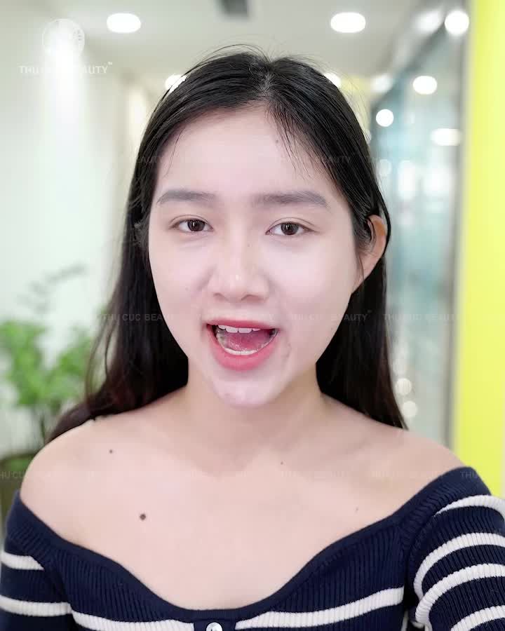 Từ chiếc mũi thấp, gồ nhẹ và thiếu cân đối đến dáng mũi hài hòa sau phẫu thuật