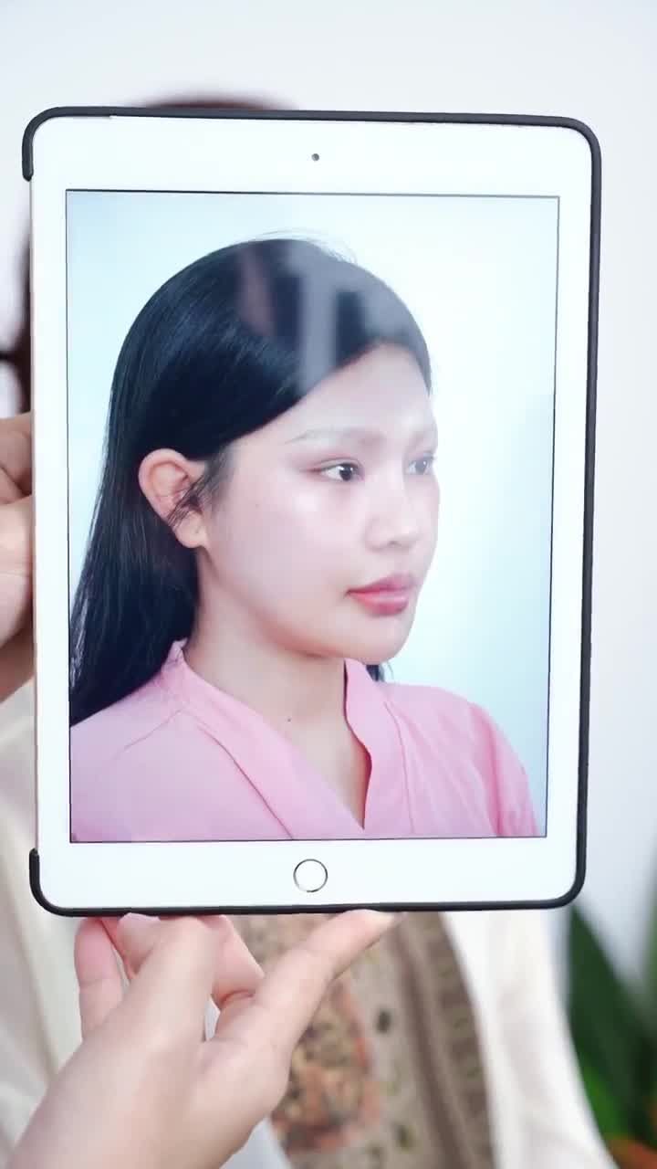 SAU 10 NGÀY SỬA LẠI MŨI HỎNG CÙNG DR. HOẠT