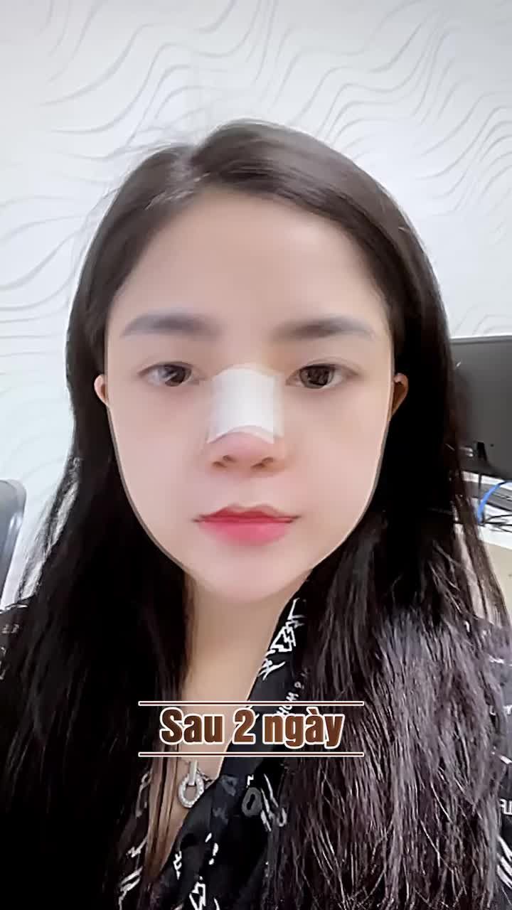 NÂNG MŨI 10 NGÀY CÓ ĐẸP THẾ NÀY THẬT KHÔNG?