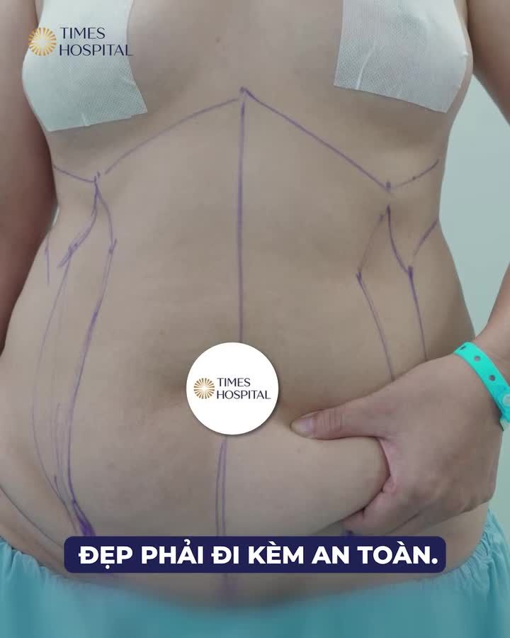 TỪ BỤNG XỔ MỠ ĐẾN VÒNG EO ĐÁNG MƠ ƯỚC!