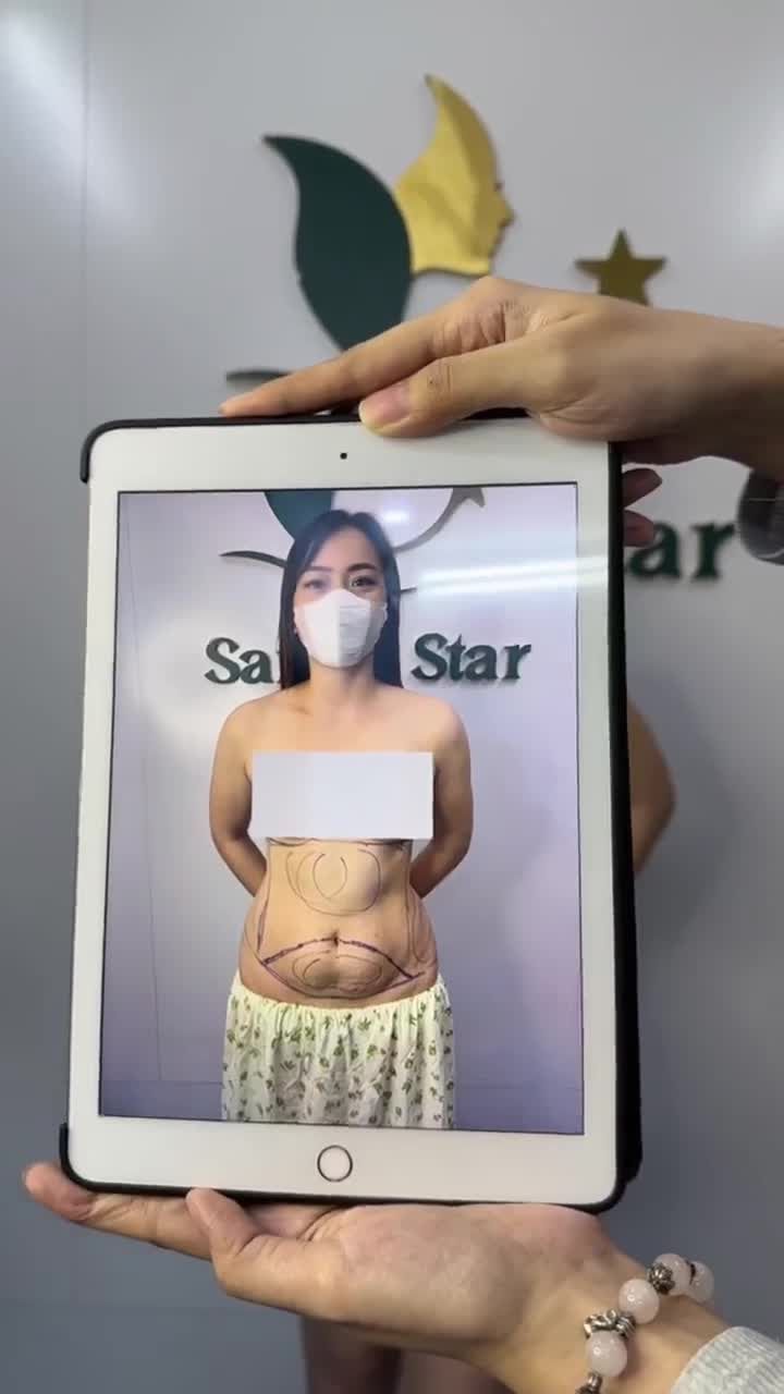 Siêu phẩm HÚT MỠ BỤNG 360° + CĂNG DA BỤNG sau 14 ngày thực hiện