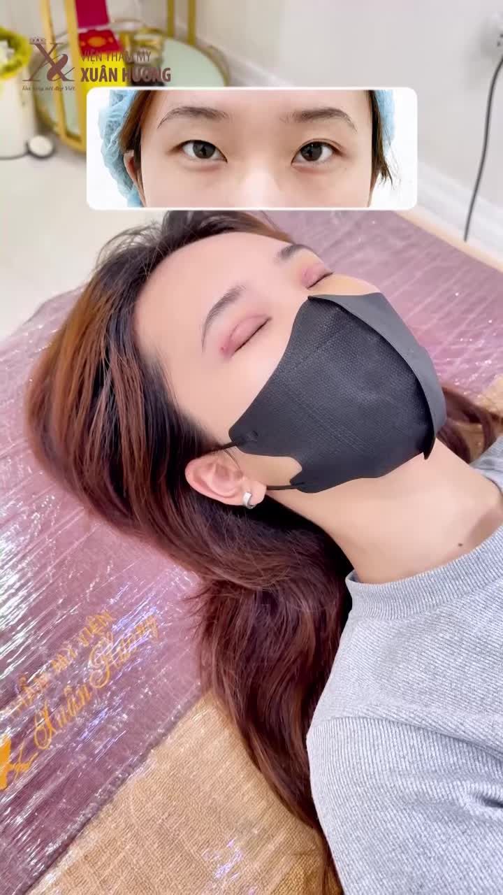 CẮT MÍ TRÊN - CHỈ 5 NGÀY ĐÃ THẤY KHÁC BIỆT