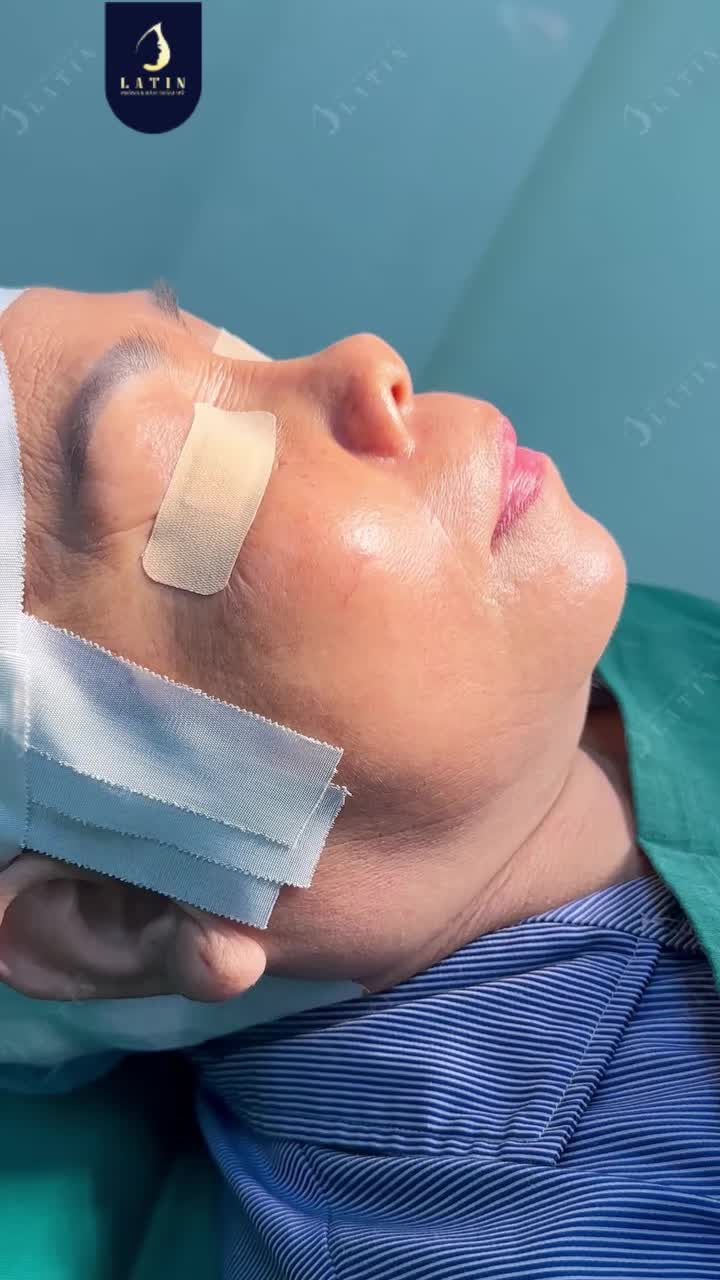 NÂNG MŨI – NÂNG CUNG MÀY    MỘT GÓC NGHIÊNG U50, HAI PHIÊN BẢN NHAN SẮC