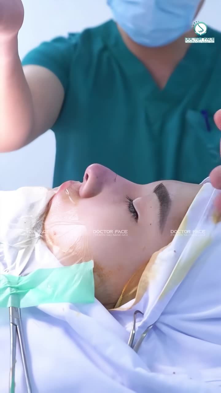 Cần gì đợi tháo nẹp, form mũi vừa xong đã đủ kéo thần thái lên rồi