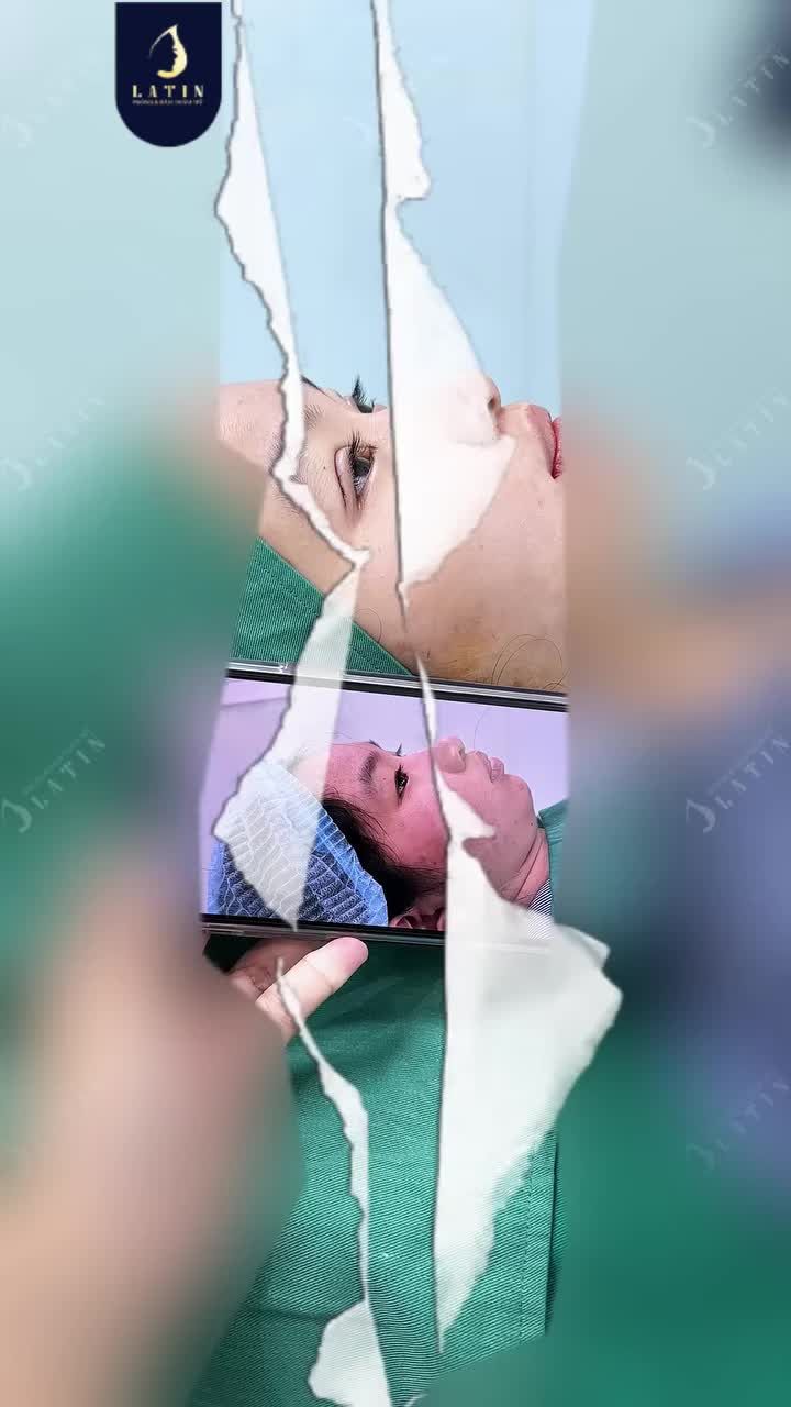 MỘT CHÚT THAY ĐỔI Ở MŨI VÀ MẮT – ĐỦ ĐỂ GƯƠNG M.ẶT THANH THOÁT HƠN