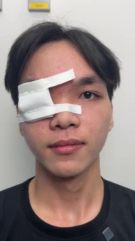 CỰC HOT: Chàng trai 2K8 miền Tây hoá nam thần chỉ sau 7 ngày điều trị SỤP MI bằng CHUYỂN VẠT CƠ TRÁN tại JW