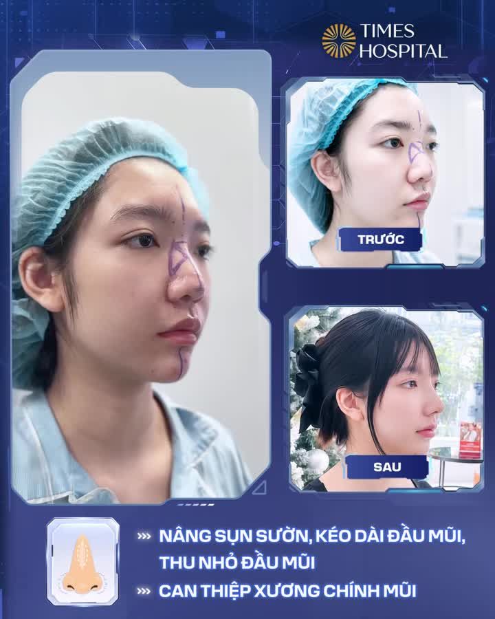 NÂNG MŨI TỰ NHIÊN – LÊN HÌNH ĐẸP KHÔNG CẦN FILTER