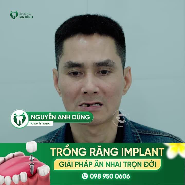TOP 4 KHÁCH HÀNG ĐANG TRỒNG RĂNG IMPLANT TẠI NHA KHOA GIA ĐÌNH