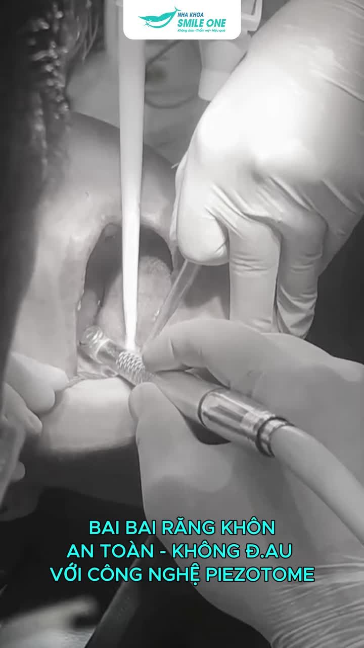 TẠM BIỆT RĂNG KHÔN KHÔNG ĐAU CÙNG NGUYỄN VÂN HOÀNG