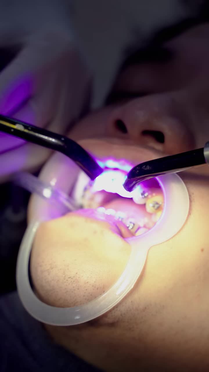 CHỈNH NHA LẠI CHO KHÁCH HÀNG ĐÃ TỪNG NIỀNG RĂNG Ở ĐƠN VỊ KHÁC