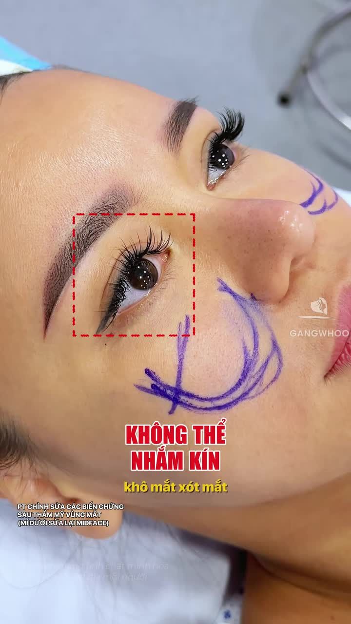Mí lật, không khép kín mắt và kết quả sau khi sửa lại mí dưới