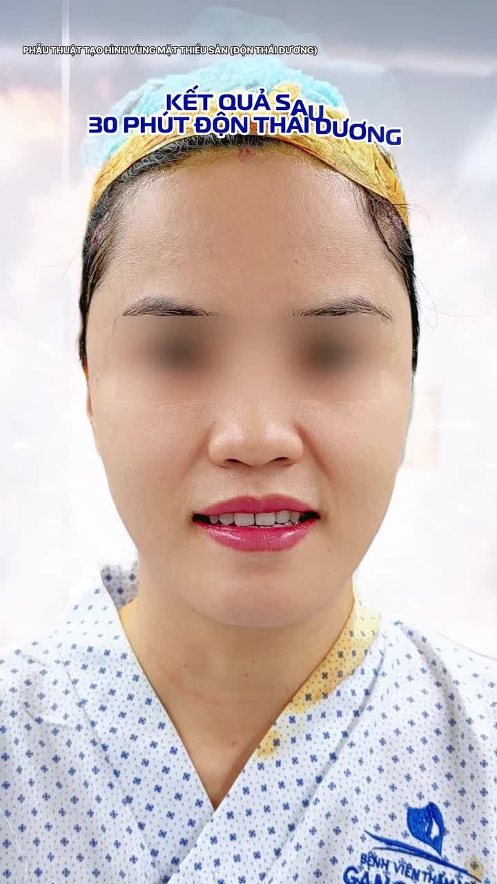 Ít ai ngờ thủ phạm khiến gương mặt già nua chính là vùng thái dương hóp