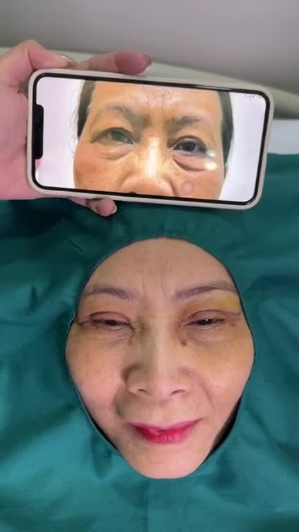Quý cô U70 Phú Yên chơi lớn CẮT DA, BỎ MỠ THỪA tại JW thành công sở hữu đôi mắt TRẺ 20 TUỔI chỉ sau 7 ngày