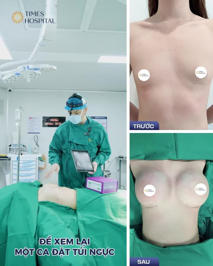 NGỰC LỆCH, MÔ MỎNG, DA CĂNG  CHỈ ĐẶT TÚI NGỰC LIỆU ĐÃ ĐỦ TỰ NHIÊN