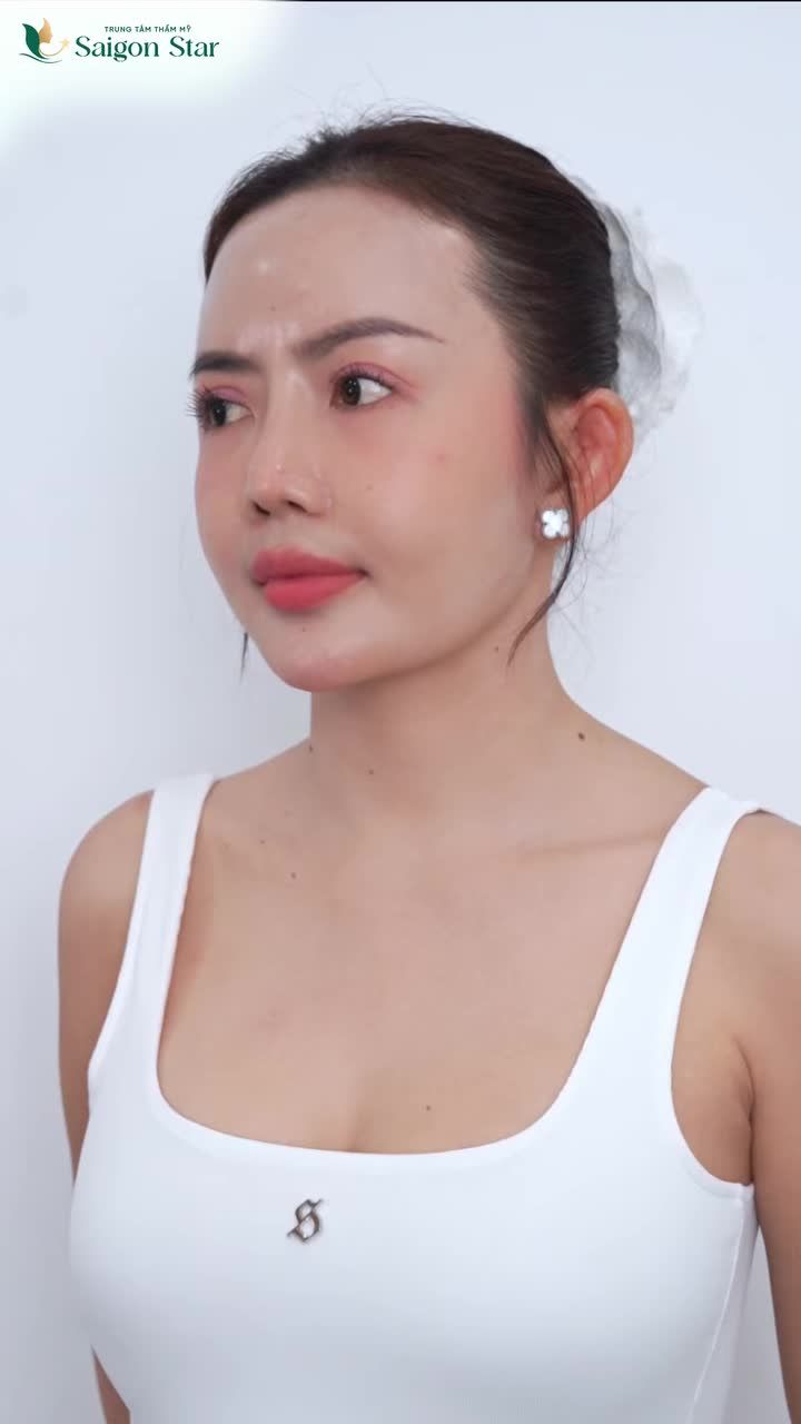 7 tháng sau sửa mũi hỏng... visual lên nốt cao luôn!