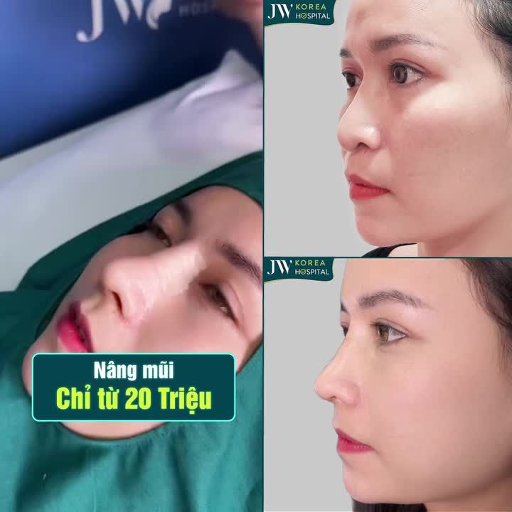 TẠM BIỆT MŨI THẤP TẸT, NGƯỜI ĐẸP TÂY ĐÔ THĂNG HẠNG NHAN SẮC SAU 7 NGÀY NÂNG MŨI S LINE 3D TẠI JW